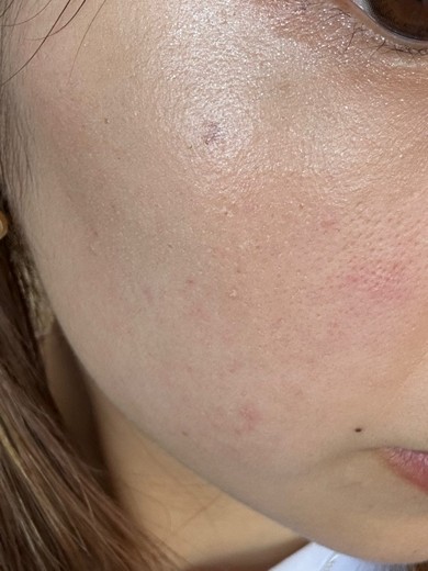 before photo: IPL(光/フォト治療), ルメッカ