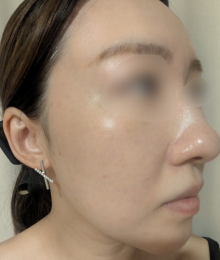after photo: IPL(光/フォト治療), ピーリング