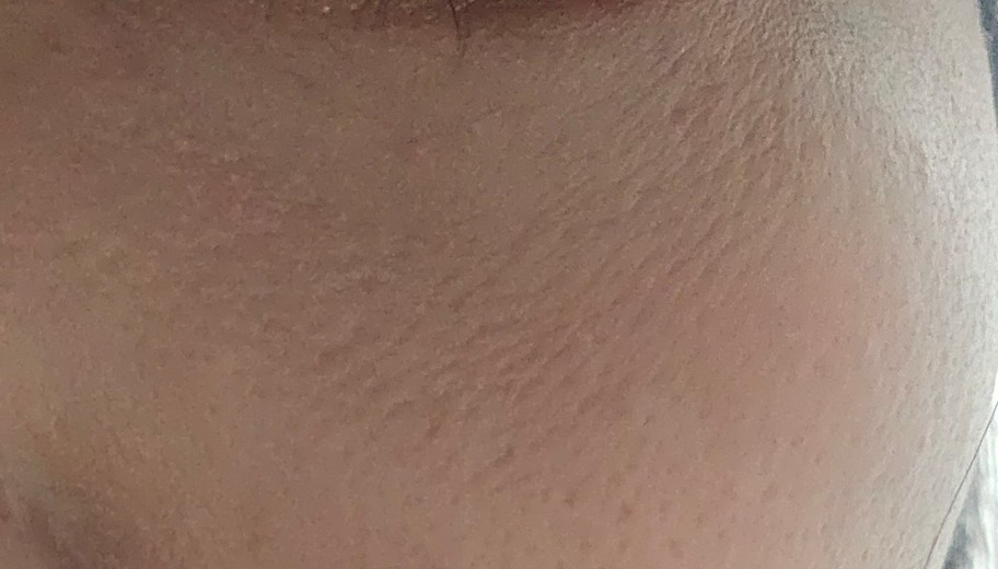 after photo: 리쥬란아이