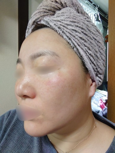 after photo: ダーマペン