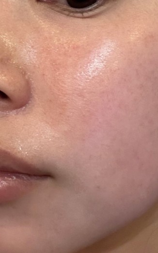before photo: サーモン注射