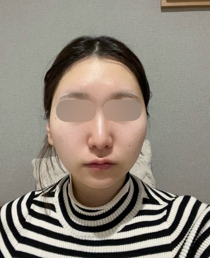 after photo: IPL(光/フォト治療)