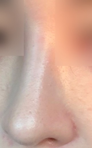 after photo: 콧대(보형물), 코끝(자가연골)