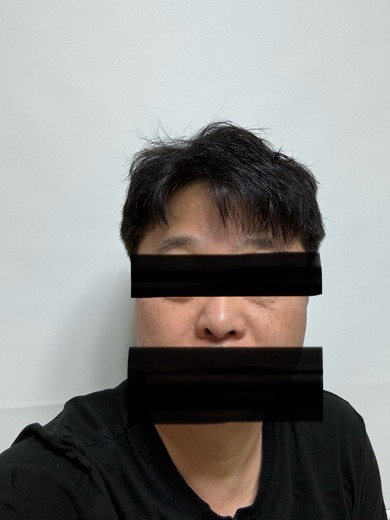 before photo: 눈밑지방재배치