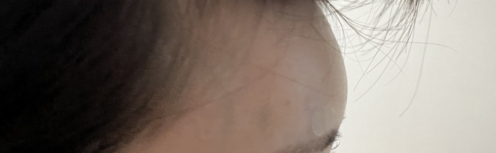 after photo: 이마필러, 관자놀이필러