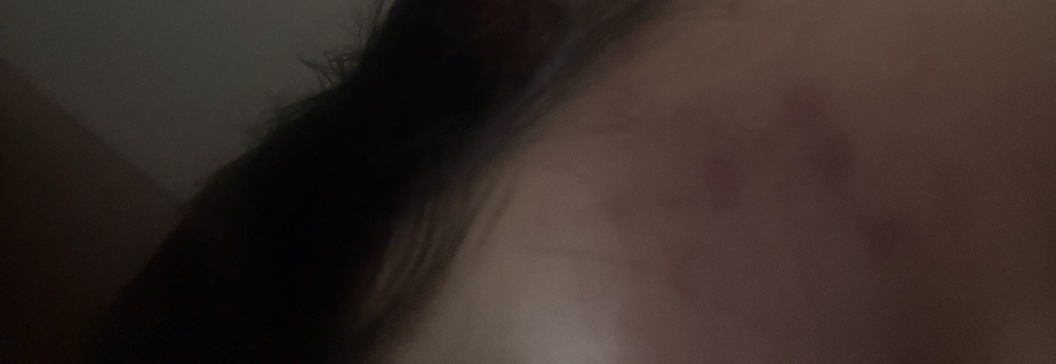 after photo: 여드름압출, 여드름주사