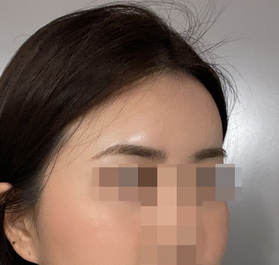 after photo: 이마필러