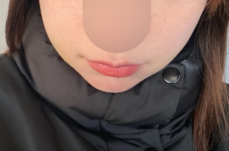 after photo: 脂肪吸引(顔)