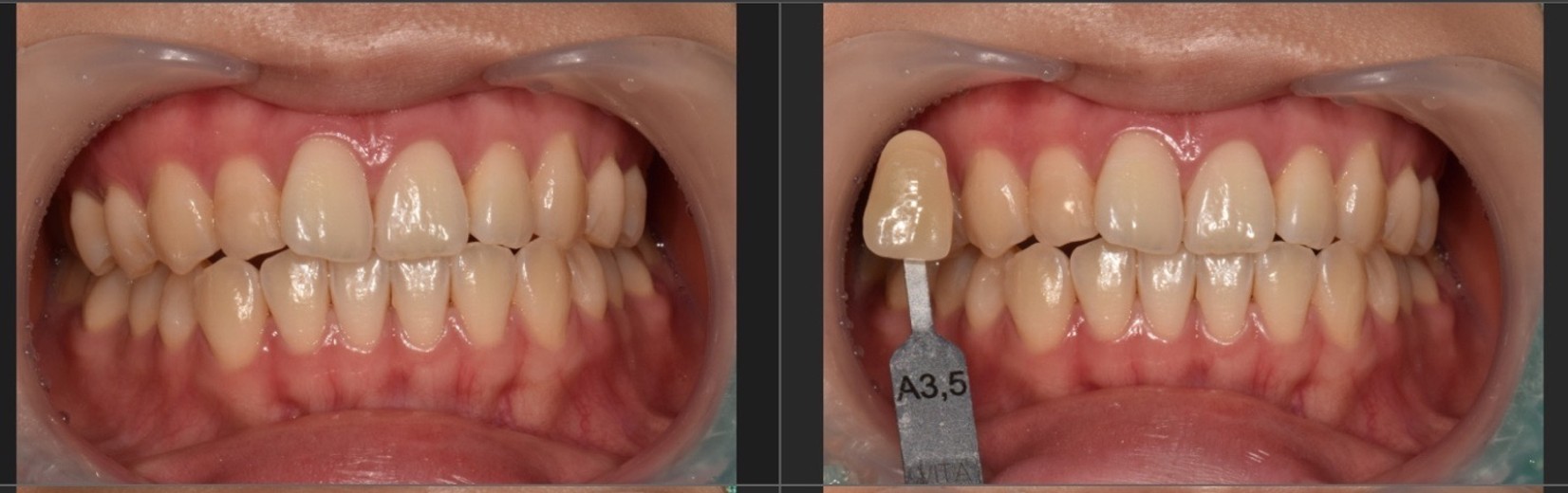 before photo: 치아미백