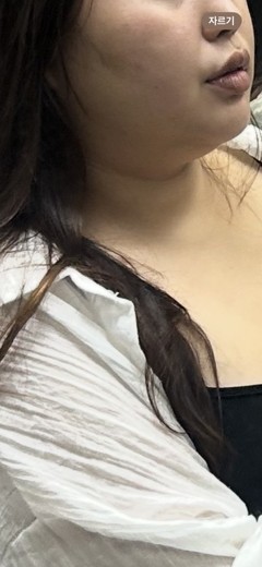 before photo: 아쿠아필링