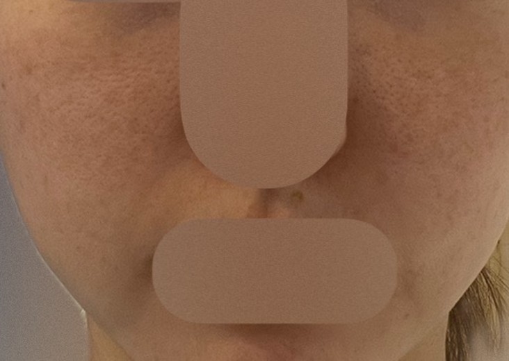 before photo: 리쥬란힐러