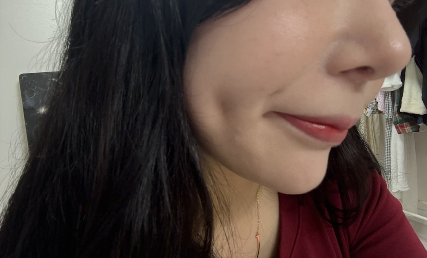 after photo: 보조개성형