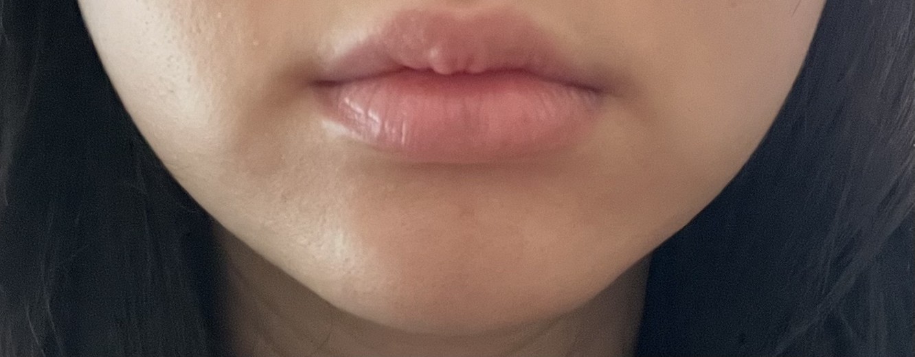 after photo: 윤곽주사