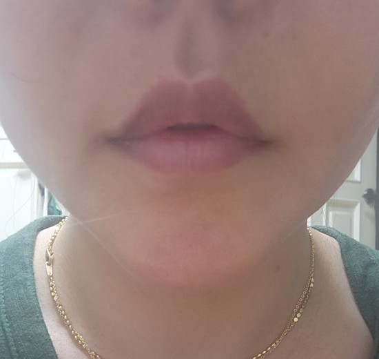 after photo: 턱끝보톡스, 턱끝필러