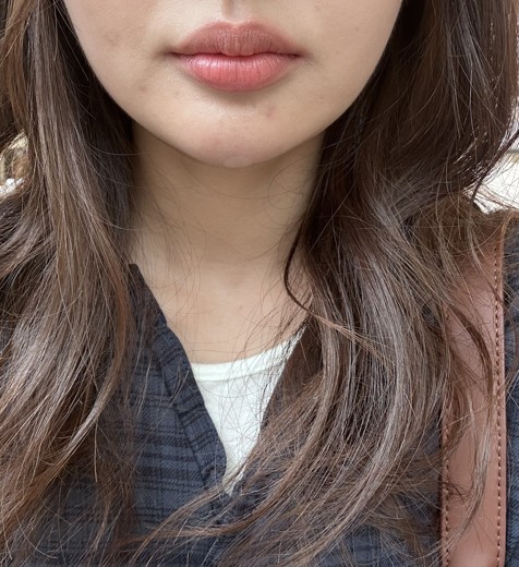 after photo: 턱끝보톡스, 턱끝필러