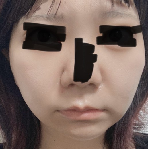 after photo: 糸リフト
