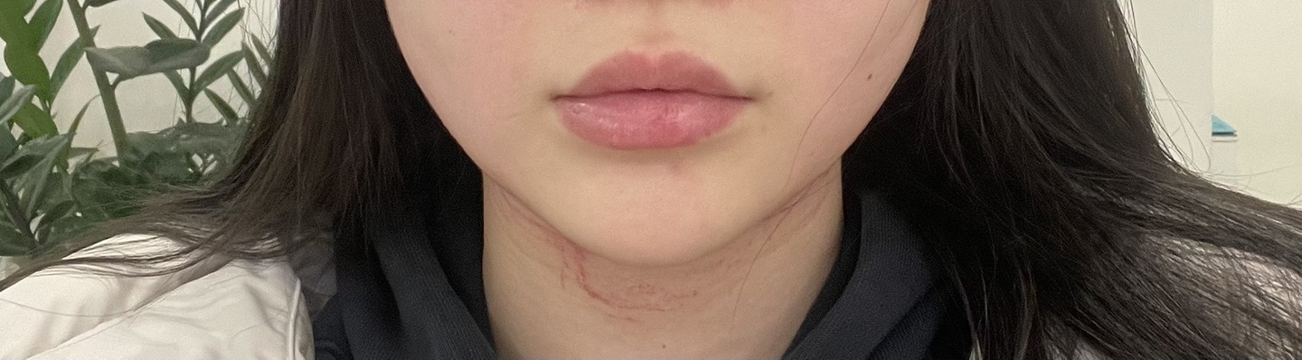 before photo: 인모드리프팅