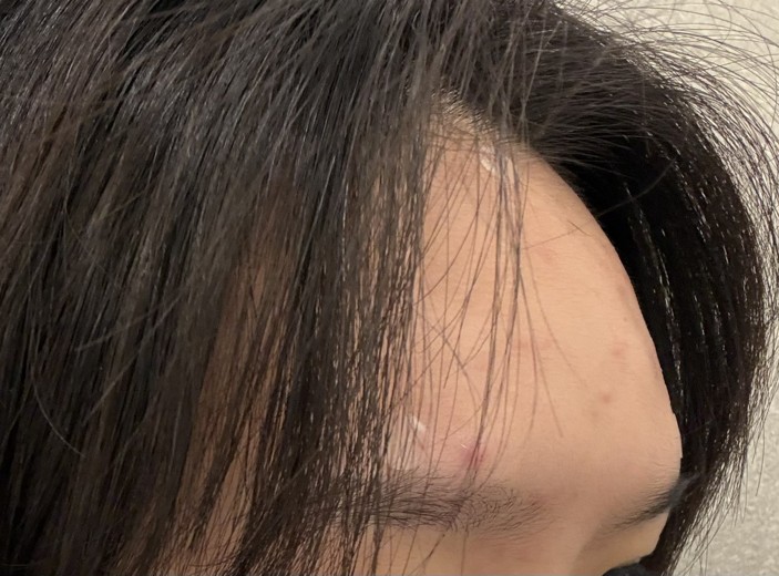 after photo: 이마필러, 관자놀이필러