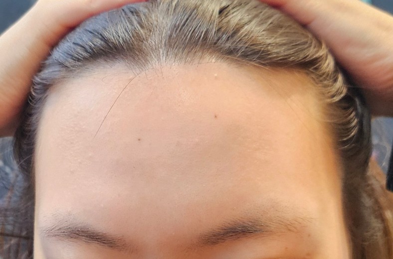 before photo: 머리모발이식