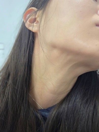 after photo: 침샘보톡스