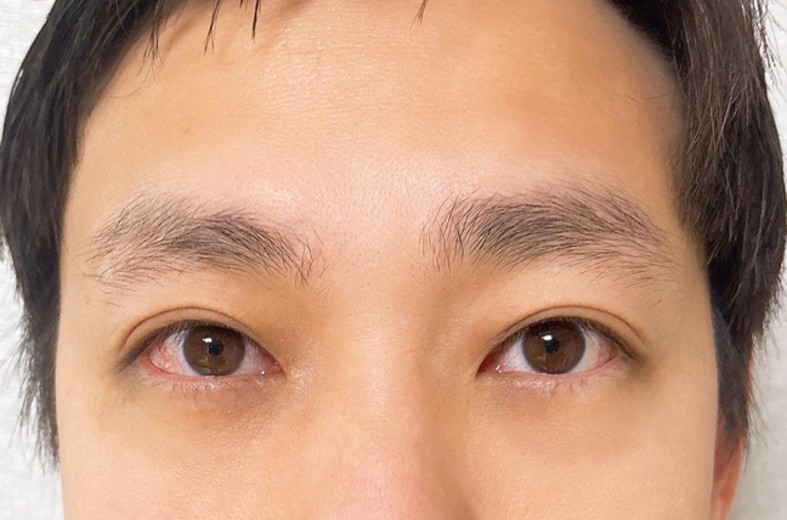 after photo: 눈밑지방재배치