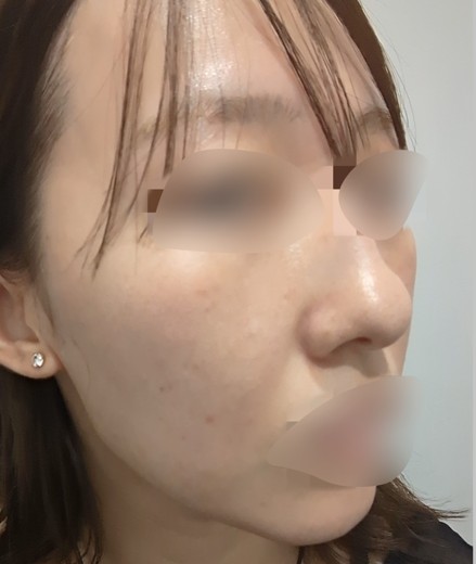 before photo: ルメッカ