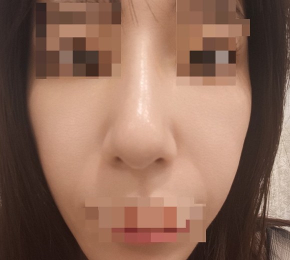 after photo: IPL(光/フォト治療), ピーリング, エレクトロポレーション
