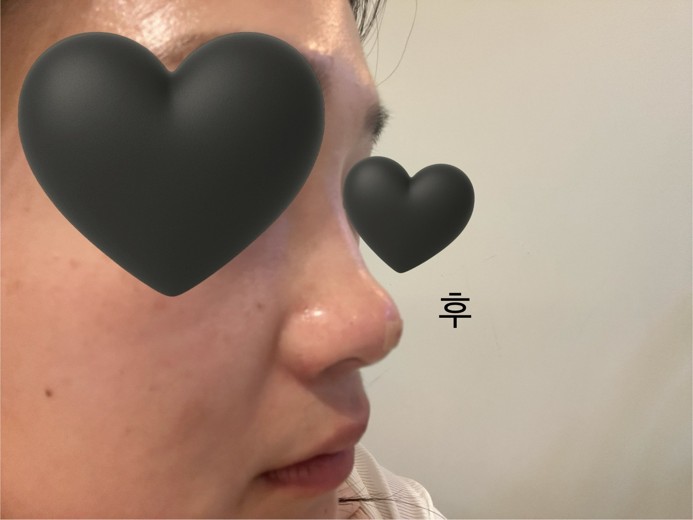 before photo: 코실리프팅