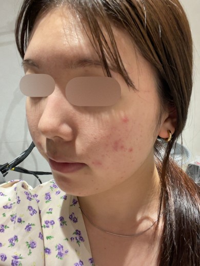 before photo: ピーリング, ララピール(LHAピーリング)