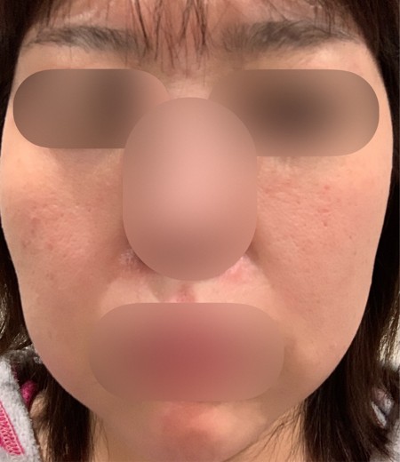 after photo: エレクトロポレーション, ハイフ(HIFU)