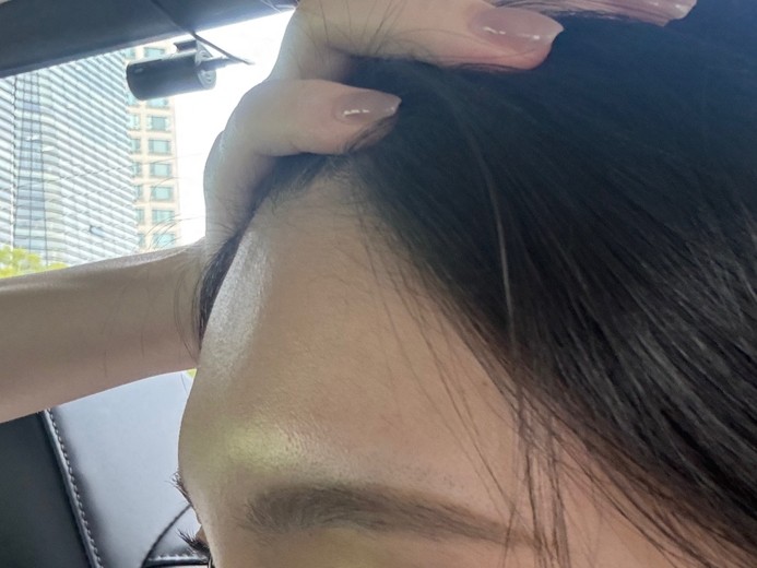 before photo: 이마필러