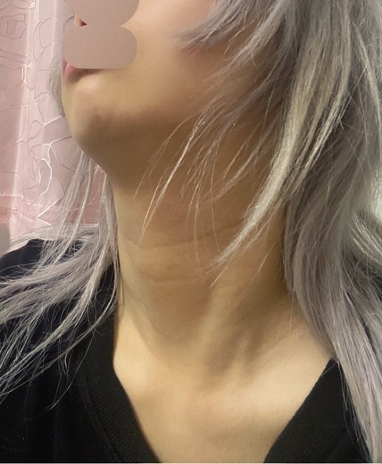 after photo: 首・広頚筋ボトックス