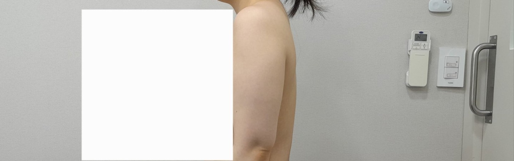 before photo: 脂肪吸引(腕)