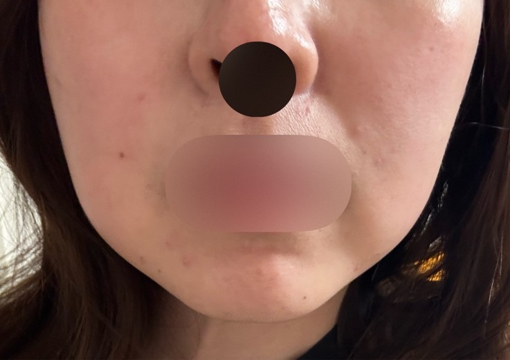 after photo: 脂肪溶解注射(顔)