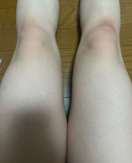 after photo: 脂肪冷却(太もも)