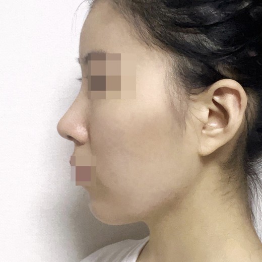 after photo: 코끝(자가연골)