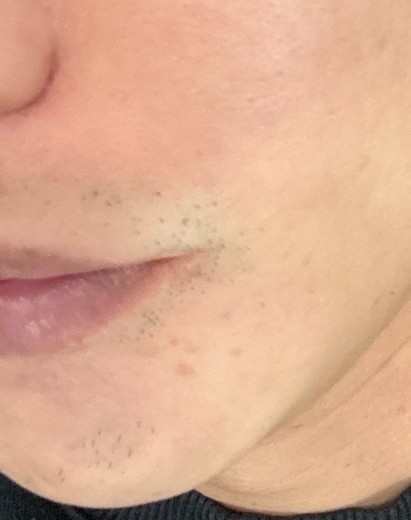 after photo: 인중제모