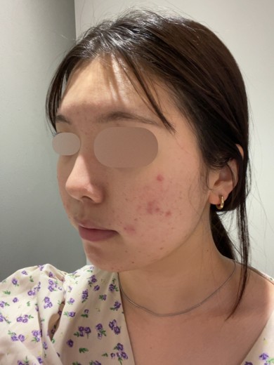 after photo: ピーリング, ララピール(LHAピーリング)