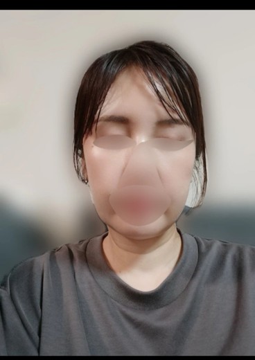 after photo: IPL(光/フォト治療), エレクトロポレーション