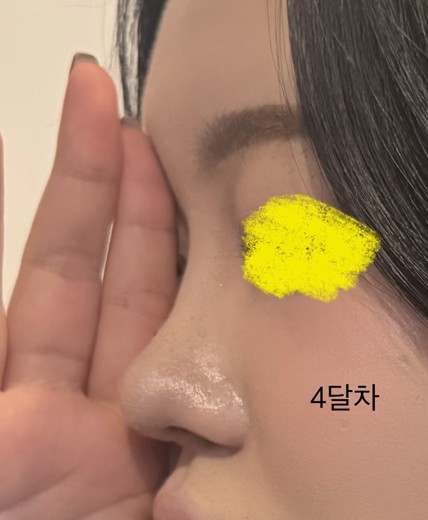 after photo: 콧대(보형물), 코끝(자가연골), 비후성비염수술