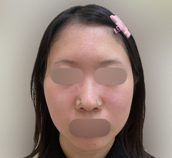 before photo: 脂肪溶解注射(顔)