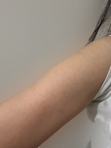 before photo: 팔지방분해주사