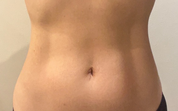 スノエル（脂肪冷却）2パーツ4ハンドル 部分痩せしたい方◎ | オルタ