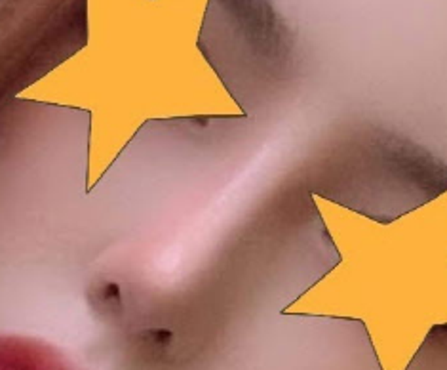 after photo: 코재수술