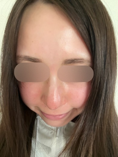 before photo: ダーマペン