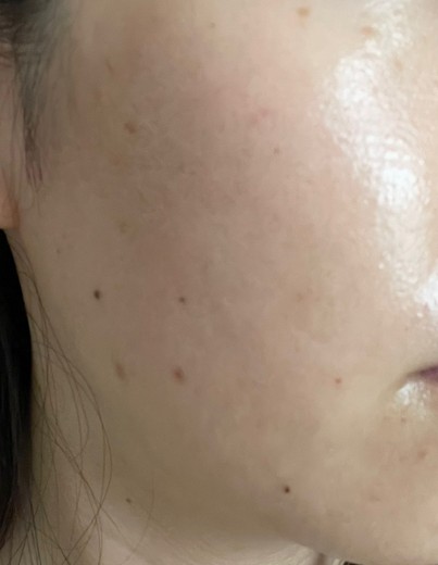 after photo: IPL(光/フォト治療)
