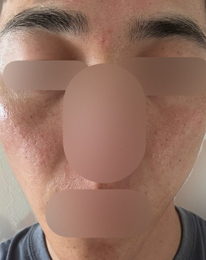 before photo: ピコフラクショナル