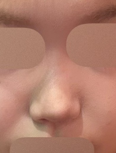 before photo: 비중격만곡증수술, 콧대(보형물), 코끝(자가연골)