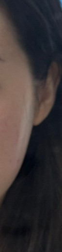 after photo: 옆볼필러