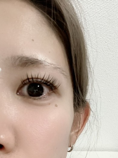 after photo: 涙袋ヒアルロン酸, 鼻ヒアルロン酸